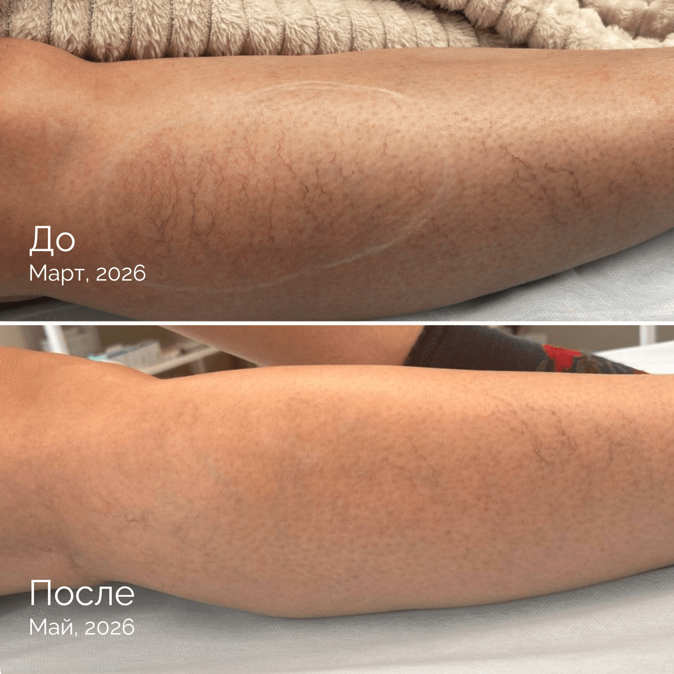 Два месяца, одно решение — и ноги, с которыми не страшно встречать лето - Estonian Vein Clinic