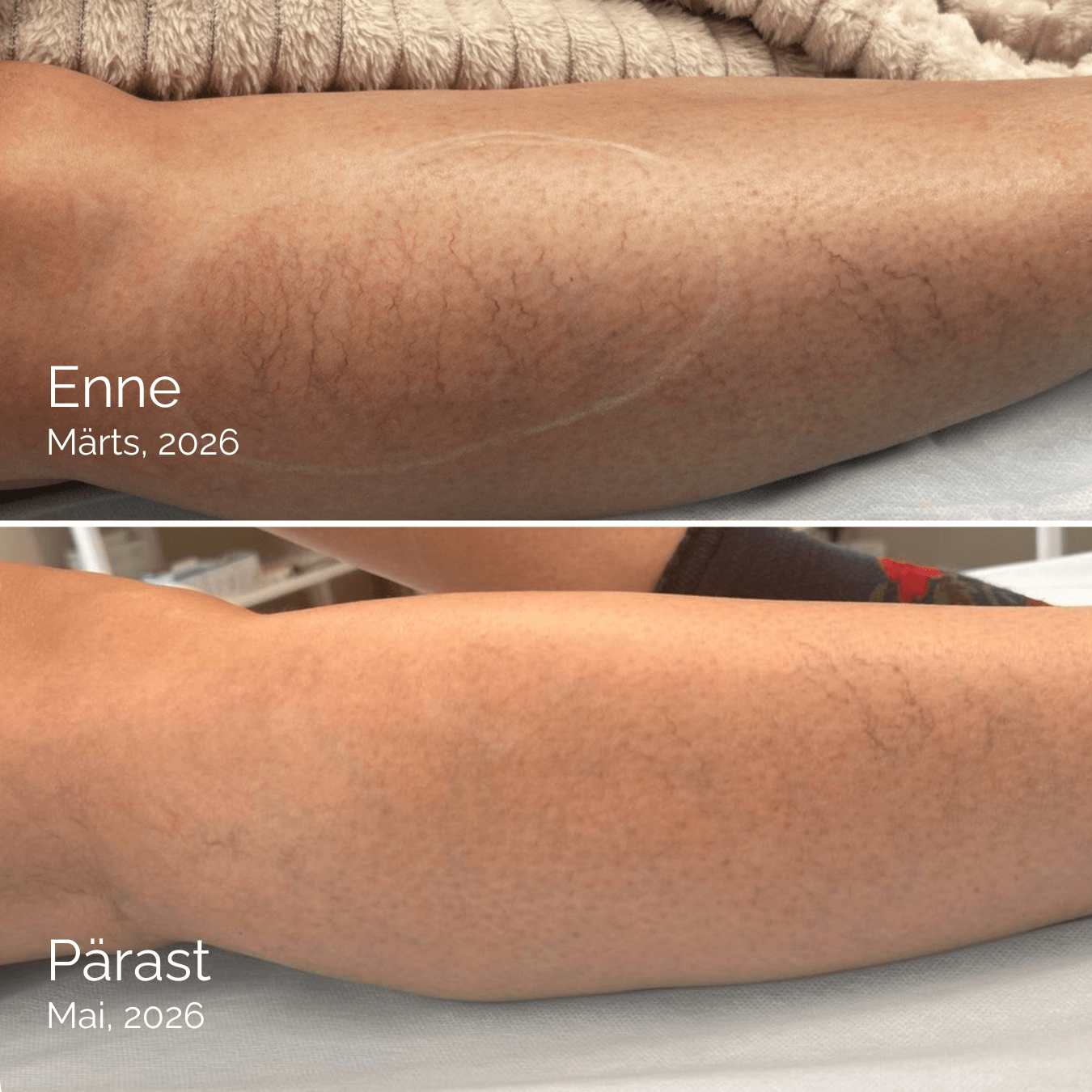 Kaks kuud, üks otsus — ja jalad, millega julgeb suvesse minna - Estonian Vein Clinic