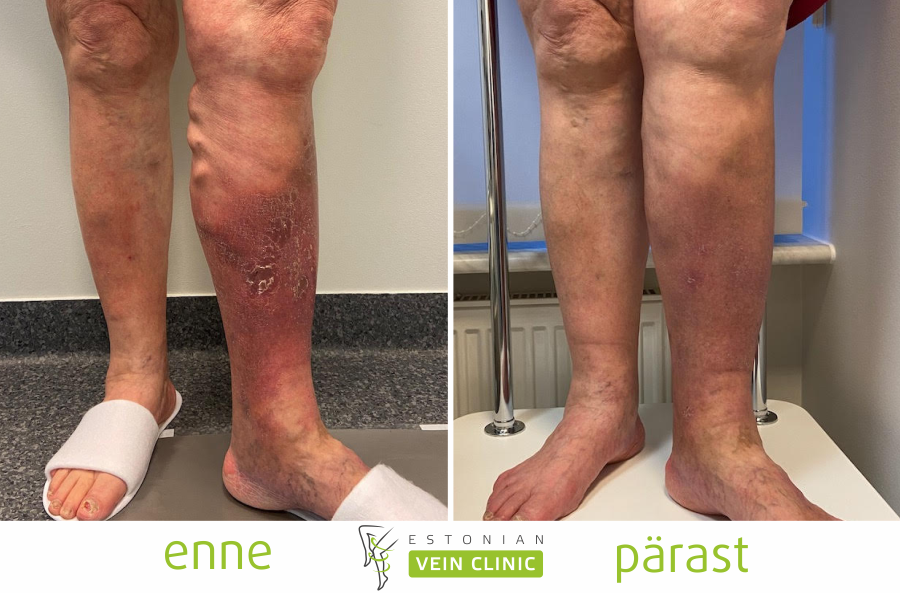 Suonikohjut ja niiden hoito: mitä jokaisen suomalaisen kannattaa tietää ennen päätöstä - Estonian Vein Clinic
